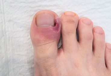 درمان عفونت ناخن پا