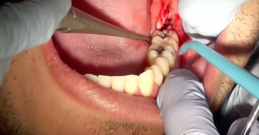 🦷 جراحی دندان‌های عقل و نهفته: علل، روند و مراقبت‌ها