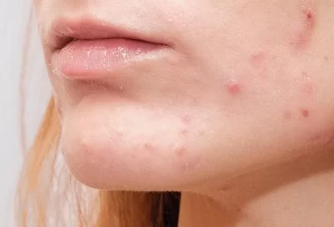 اثرات استرس مزمن بر پوست: از آکنه تا پیری زودرس