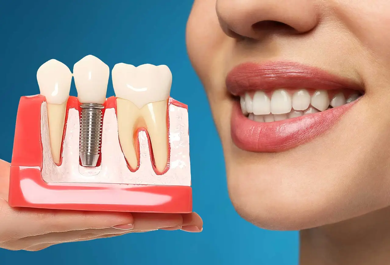 کاشت ایمپلنت دندانی در کرج توسط بهترین دکتر ایمپلنت | تجربه لبخندی دائمی با بامادنت