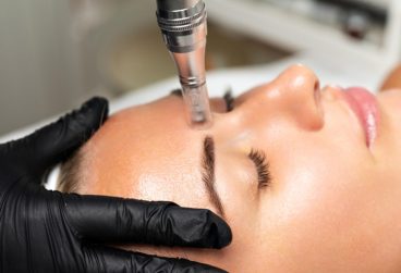 میکرونیدلینگ: چگونه جای زخم‌ های قدیمی آکنه را برای همیشه محو کنید؟